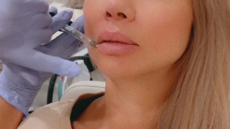 lip filler